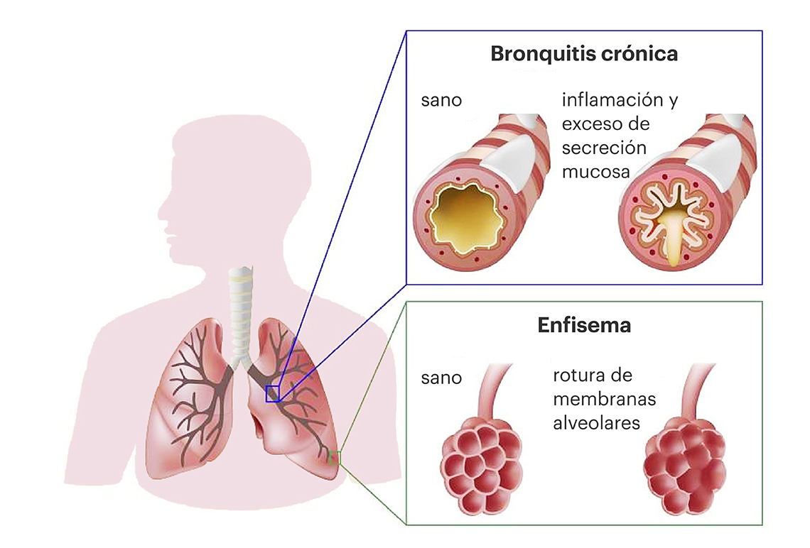 Avances En Respiratorio | EPOC (enfermedad pulmonar obstructiva ...